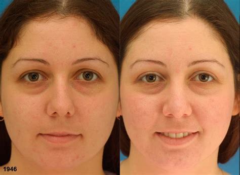 upturned nose piggy nose correction nyc dr philip miller