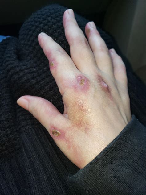 Don't let the Drs tell you it's just a rash or eczema : r/dermatomyositis