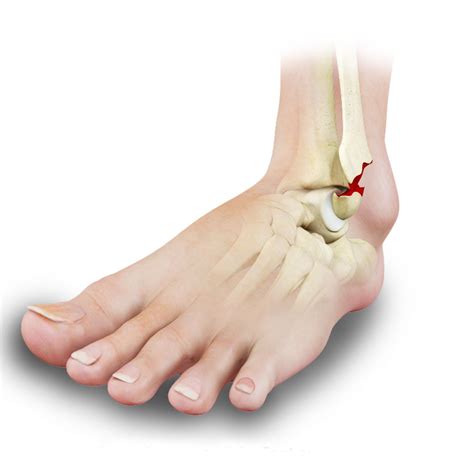 ANKLE FRACTURE