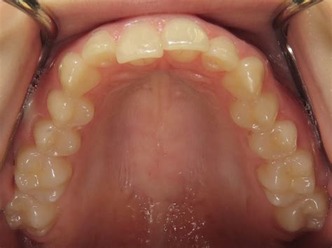 SureSmile Clear Aligner Therapy - Ellis Family Dentistry