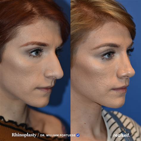 nose job recovery timeline - Karma Autry