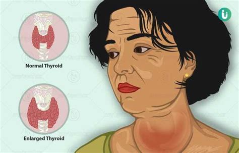 Goiter: symptoms, causes, treatment, medicine, prevention, diagnosis