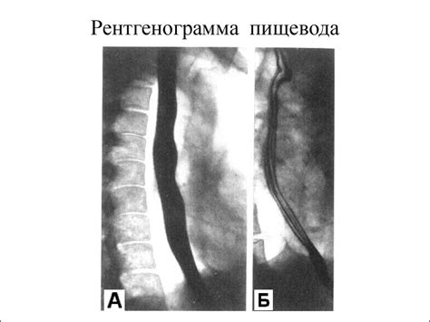 Физиология пищевода. Глотание. Лекция - презентация онлайн