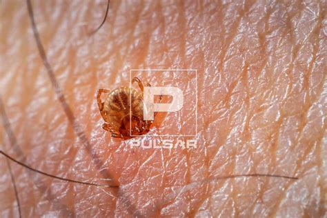 Carrapato Estrela Filhote - Detalhe de carrapato-estrela na pele humana - também denominado ...