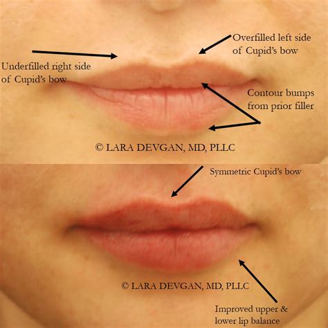 lip line bump 5