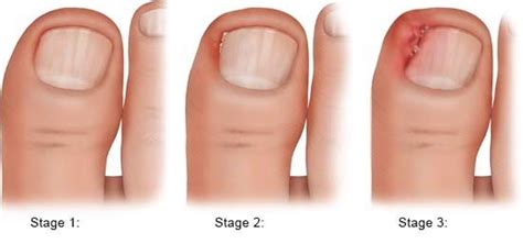 Ingrown toenail | informedhealth.org