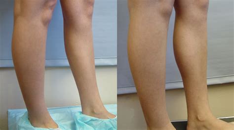 Calf Implant Images | Calves Augmentation | Chugay Cosmetic Surgery ...