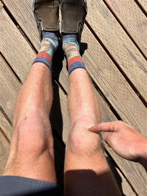 Tons of fluid on my knee a month after bruising it mountain biking