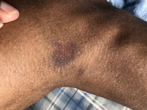 Bruising on the right side of my right knee towards the back. Is this a