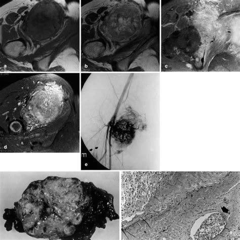 a–c Alveolar soft part sarcoma with very high serpentine signals on the ...