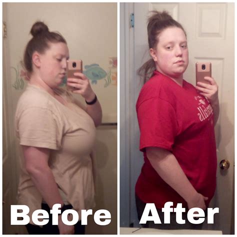 Breast Reduction Before And After Ddd