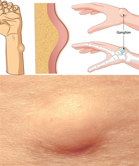 wrist ganglion  symptoms  effective treatments iadun