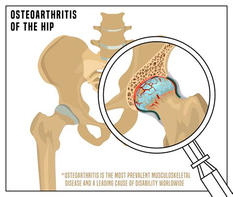hip-osteoarthritis-physio | Simply Align Rehab