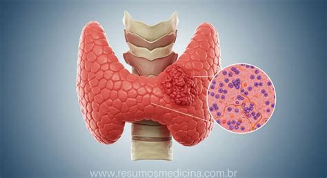O Que Causa Cancer Na Tireoide - Câncer de Tireoide Descomplicado: Tipos, Diagnóstico Completo e ...
