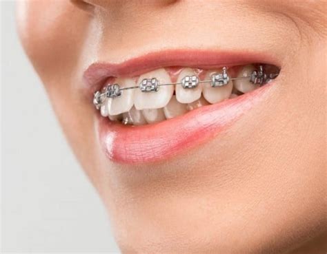 Traditional Metal Braces Treatment - Ehrler Orthodontics