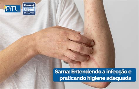 Tive Contato Com Uma Pessoa Com Sarna O Que Fazer - Sarna: Entendendo a infecção e praticando higiene adequada