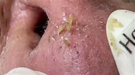 Forget Everything You Know: Unbelievable Blackhead Removal 2024 Revealed - ri20jhd