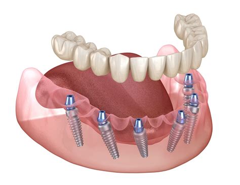 Full Arch Dental Implants Boston MA | Full Mouth Implants Cambridge MA