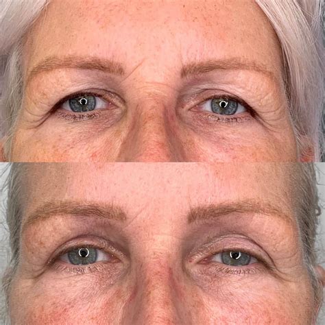 Botulinum Toxin Botox - Sero Aesthetics.co.uk