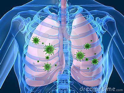 Infecção Pulmonar É Contagiosa - INFECÇÃO PULMONAR - O que é, como identificar e como é o seu tratamento ...