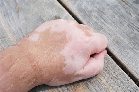 premium photo male hand  vitiligo skin condition