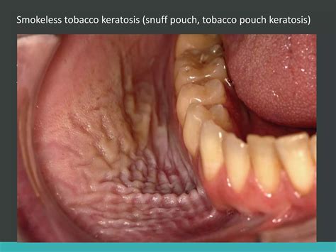 White lesions of oral cavity | PPTX