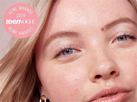 Unbelievable Blackhead Removal 2024: Results You Won't Believe Are Possible! Image 12