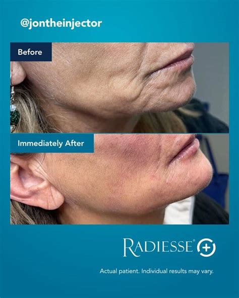 Radiesse Rosto Antes E Depois - Radiesse para rosto e corpo: quanto dura, preço, sessões e diferenças ...