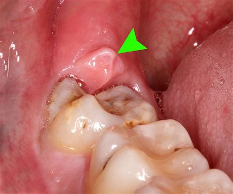Perikoronitis: Gejala, Penyebab, Diagnosis, Perawatan