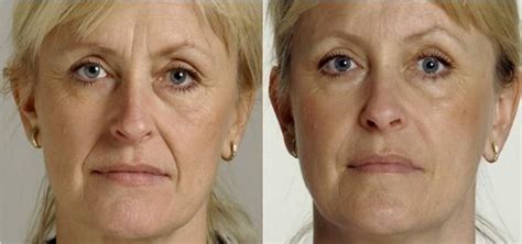 Wrinkle Fillers – Best Deep, Instant Injectable, Topical & OTC Face ...