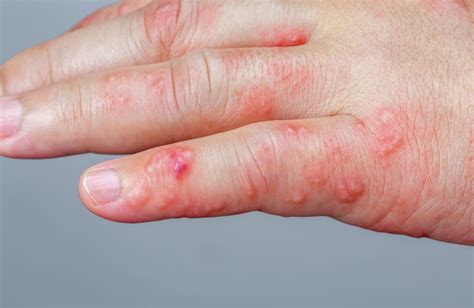 Blisters - Symptoms, Causes, Treatments