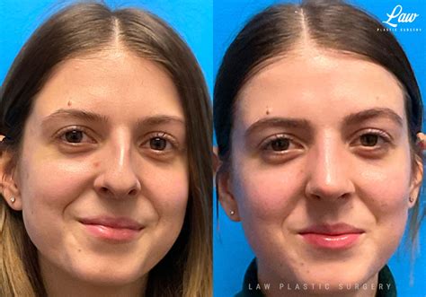 nose job  procedure
