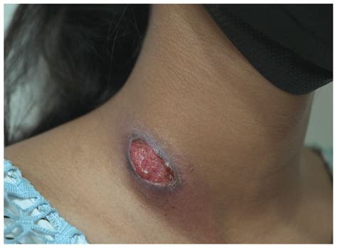 scrofuloderma    year  woman cmaj