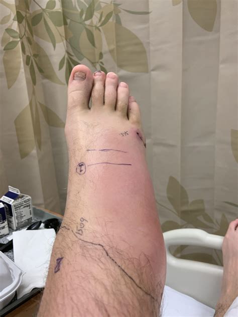 Timber Rattlesnake Bite