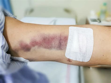 unexplained bruising  elderly nursing home patients