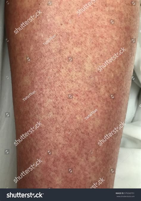 Convalescent Rash Leg Recovery Phase Dengue Foto Stok 579260791 ...