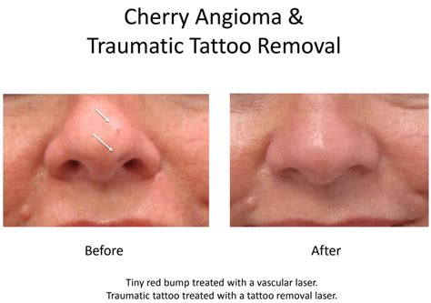 View 12 Cherry Angioma Laser Removal Before And After - townsmenwit