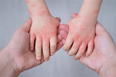 Eczema in Children: Treatment, Symptoms, and Causes