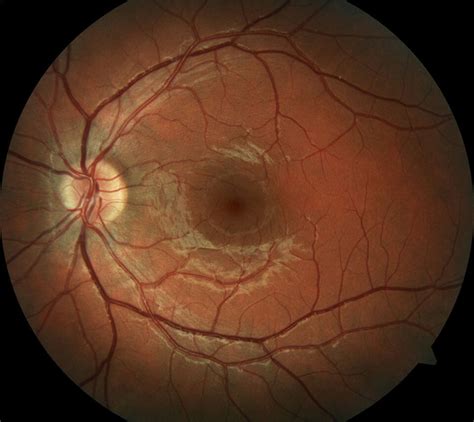 Retinal Detachment | Retina & Vitreous of LA