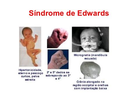 estomatologia: ¿¿¿SABES QUE ES EL SÍNDROME DE EDWARDS???