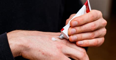 topical steroid withdrawal syndrome penarc