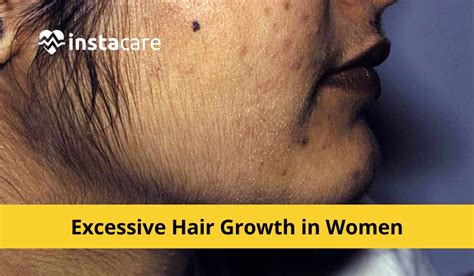 Hirsutism: Symptoms Treatment Causes Of Excess Facial Hair In Women ...