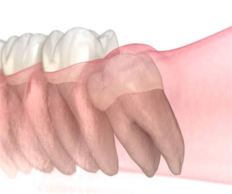 mesial angle stock  pictures royalty  images istock