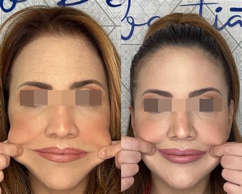 Radiesse Deixa O Rosto Gordo - Radiesse: Antes e depois
