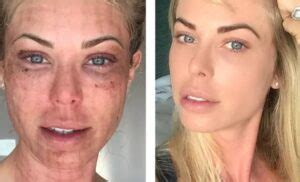 Oxandrolona Antes E Depois - Oxandrolona: Antes e depois em 20 Fotos