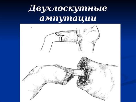 Ампутации и экзартикуляции конечностей - презентация онлайн