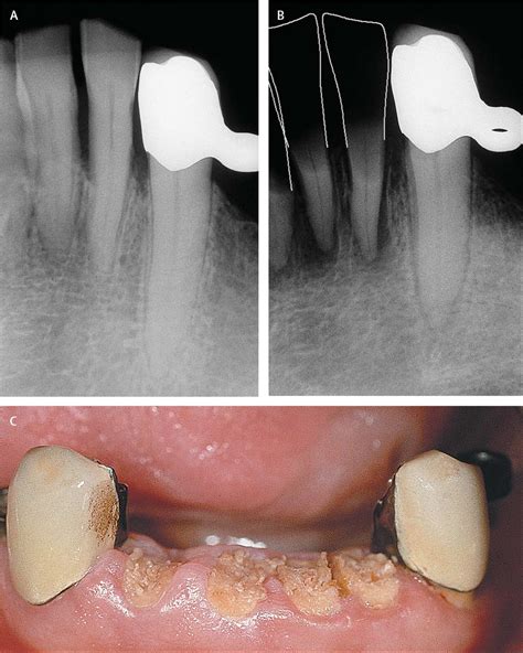 Radiation-related damage to dentition - The Lancet Oncology