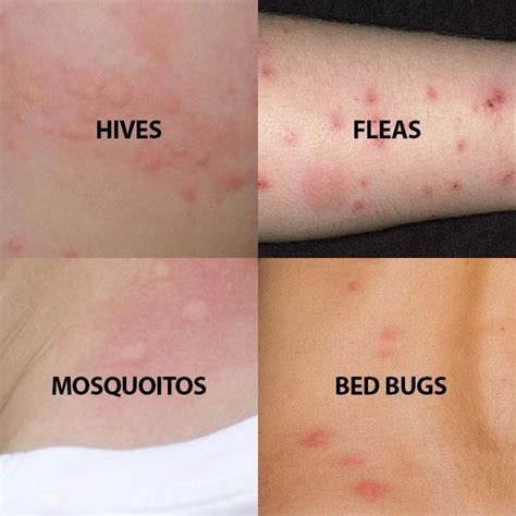 bed bug bites black wall mounted bunk ca