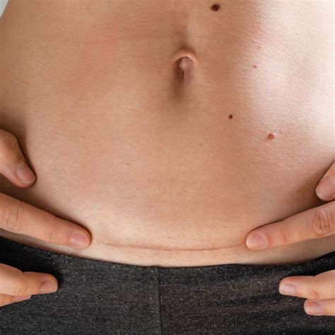 cuidados despues de una cesarea como cuidar tu cuerpo