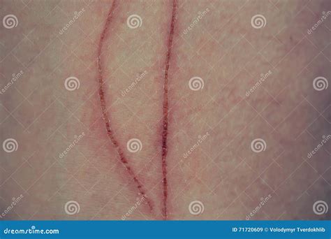 Abrasion on human skin stock image. Image of health, abrasion - 71720609